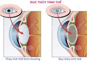 Về việc mời chào giá các mặt hàng thiết bị y tế  thủy tinh thể sử dụng trong phẫu thuật mắt năm 2025-2026  tại Bệnh viện Đa khoa khu vực miền núi phía Bắc Quảng Nam
